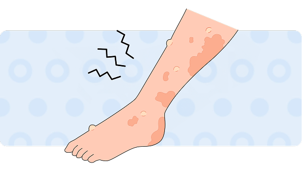 もっと知りたい水疱性類天疱瘡のこと
