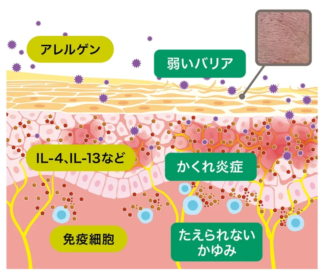 アトピー性皮膚炎の皮膚内部