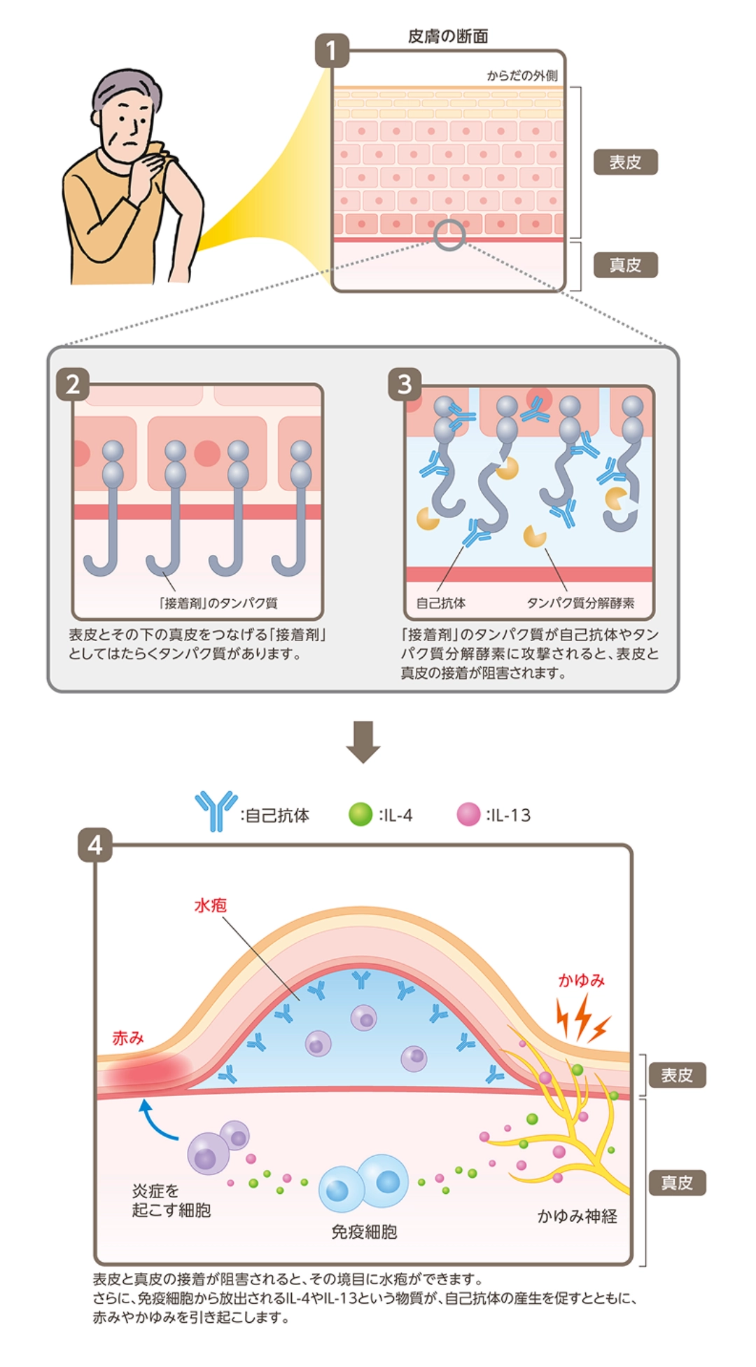 表皮とその下の真皮をつなぐ「接着剤」のはたらきをするタンパク質が自己抗体やタンパク質の分解酵素に攻撃されると表皮と真皮の接着が阻害されます。表皮と真皮の接着が阻害されると、その境目に水疱ができ、免疫細胞から放出されるIL-4やIL-13が、自己抗体の産生を促進し、赤みやかゆみを引き起こします。
