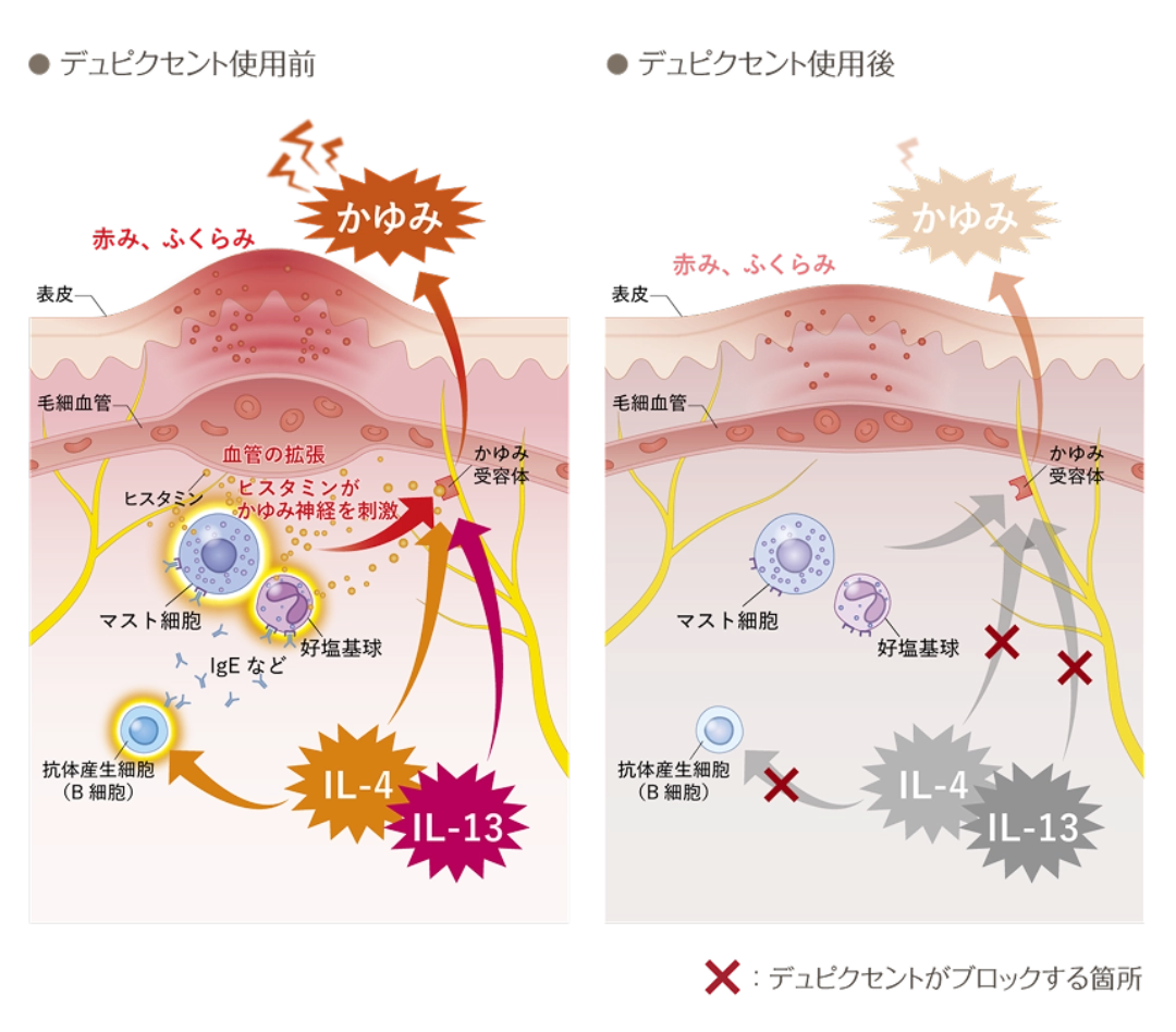 デュピクセントは、特発性の慢性蕁麻疹の炎症や症状に関わる「IL-4」と「IL-13」のはたらきをおさえることで、炎症をおさえ、皮膚の赤みやふくらみ、かゆみの改善効果を期待することができます。