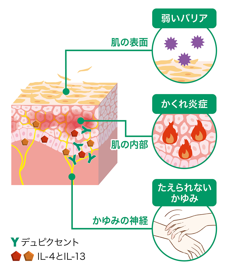 皮膚の表面で「弱いバリア」が起き、皮膚の内部で「かくれ炎症」が生じ、かゆみの神経が刺激されて「たえられないかゆみ」につながる悪循環の主役であるIL‑4とIL‑13をデュピクセントが抑える仕組みを表しています。