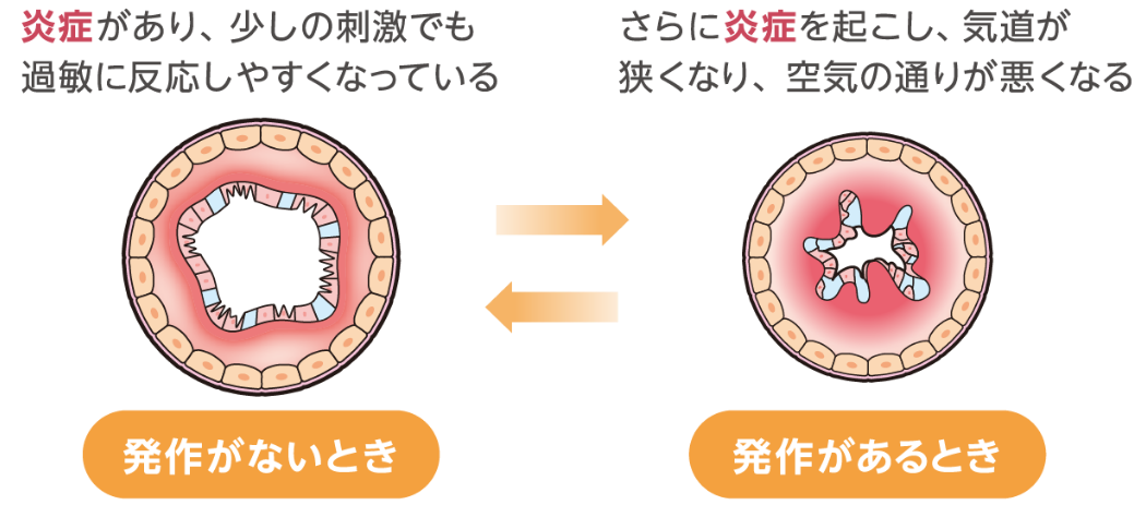 発作がないときは、炎症があり、少しの刺激でも過敏に反応しやすくなっている。発作があるときは、さらに炎症を起こし、気道が狭くなり、空気の通りが悪くなる